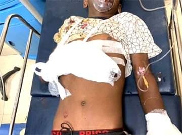 जोगता के जंगल में बेर तोड़ने गए चार बच्चे बम फटने से घायल, जालान अस्पताल में भर्ती कराया