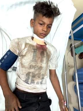 जोगता के जंगल में बेर तोड़ने गए चार बच्चे बम फटने से घायल, जालान अस्पताल में भर्ती कराया